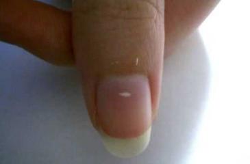 White spots on fingernails